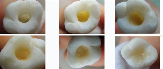 各類(lèi)牙洞型樹(shù)脂修復(fù)