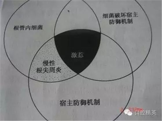 關(guān)于根管治療過(guò)程中的“激惹”現(xiàn)象
