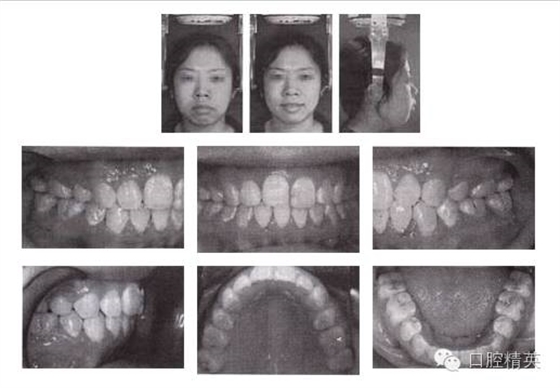拔牙矯治開頜伴前突 拔牙矯治開頜伴前突