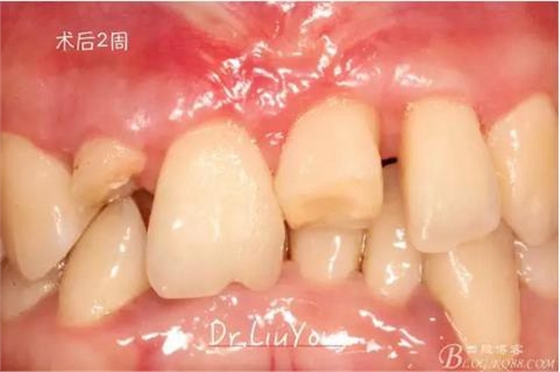 山西牙周劉勇：“前牙外傷患者的口腔多學科聯(lián)合治療”精彩案例分享