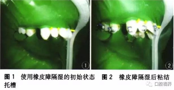 橡皮障，是用還是不用？