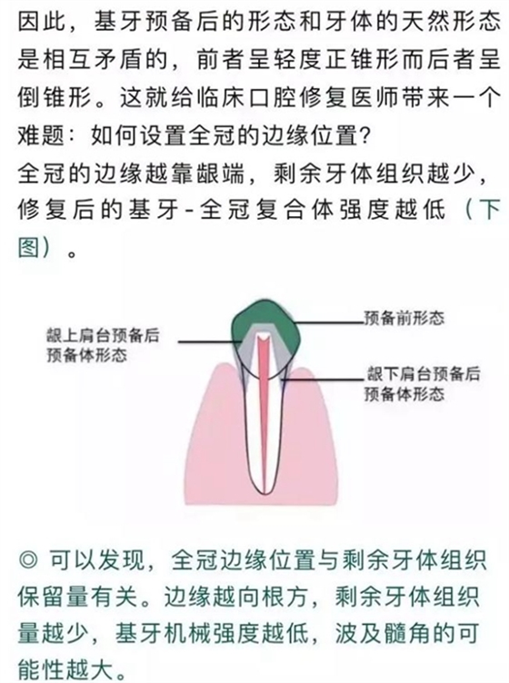 做全冠修復(fù)時基牙根面暴露，如何備牙？