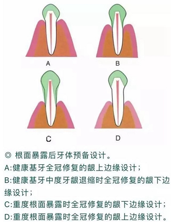 做全冠修復(fù)時基牙根面暴露，如何備牙？