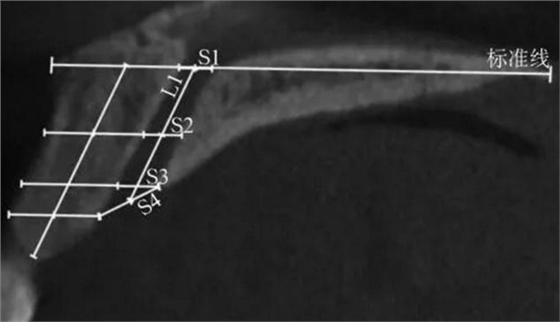 正常人群上頜前牙區(qū)鼻腭管相關(guān)解剖結(jié)構(gòu)的錐形束CT研究 正常人群上頜前牙區(qū)鼻腭管相關(guān)解剖結(jié)構(gòu)的錐形束CT研究