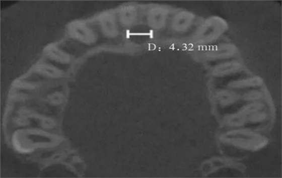 正常人群上頜前牙區(qū)鼻腭管相關(guān)解剖結(jié)構(gòu)的錐形束CT研究 正常人群上頜前牙區(qū)鼻腭管相關(guān)解剖結(jié)構(gòu)的錐形束CT研究