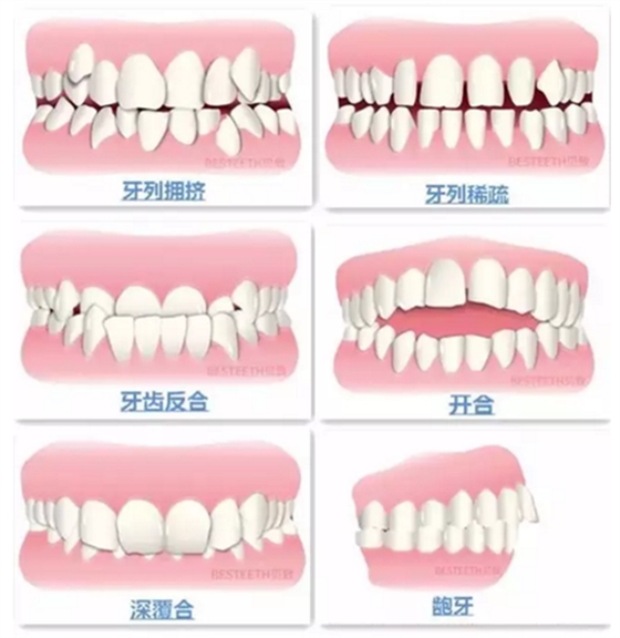 【口腔科普】關(guān)于矯牙前、中、后需要注意的問題，了解一下？