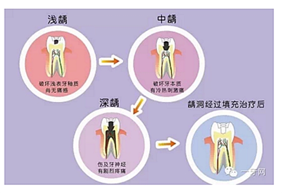 詳解牙疼的原因分幾種？