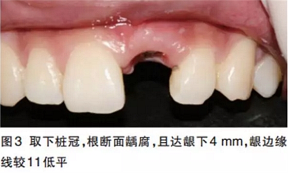 前牙即刻種植并個(gè)性化基臺(tái)美學(xué)修復(fù)