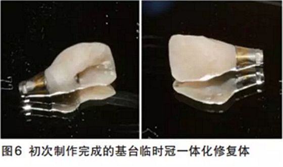 前牙即刻種植并個(gè)性化基臺(tái)美學(xué)修復(fù)