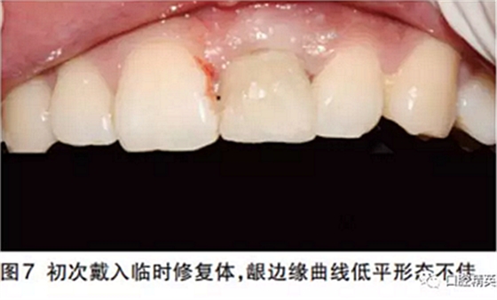 前牙即刻種植并個(gè)性化基臺(tái)美學(xué)修復(fù)