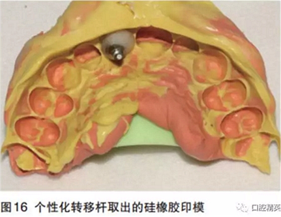 前牙即刻種植并個(gè)性化基臺(tái)美學(xué)修復(fù)