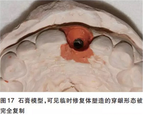 前牙即刻種植并個(gè)性化基臺(tái)美學(xué)修復(fù)