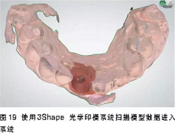 前牙即刻種植并個(gè)性化基臺(tái)美學(xué)修復(fù)