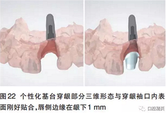 前牙即刻種植并個(gè)性化基臺(tái)美學(xué)修復(fù)