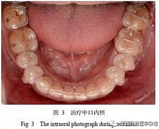 利用壓膜式活動(dòng)矯治器壓入下頜第一、第二磨牙1例