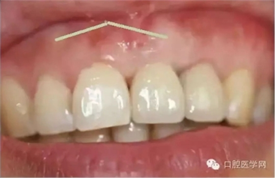 牙床骨質(zhì)突起的原因和處理措施 牙床骨質(zhì)突起的原因和處理措施