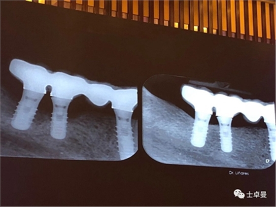 從風(fēng)險因素控制到及時有效治療，Dr. Laurence Adriaens深度解析種植體周圍炎的防治