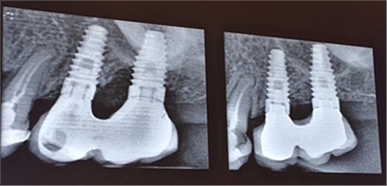 從風(fēng)險因素控制到及時有效治療，Dr. Laurence Adriaens深度解析種植體周圍炎的防治