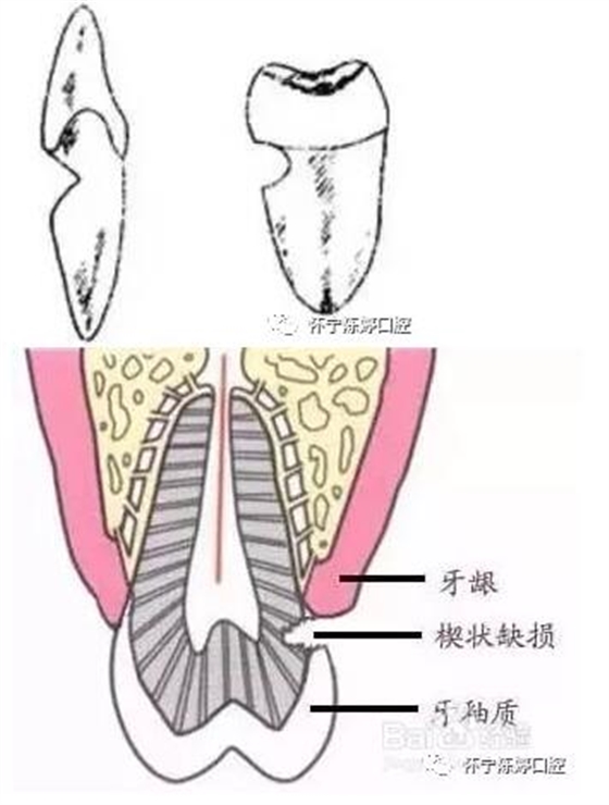 什么是牙齒楔缺？