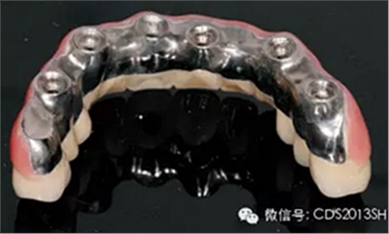 【經(jīng)驗分享】無牙頜種植修復(fù)固位的并發(fā)癥與處理——宋應(yīng)亮教授