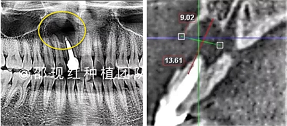 「科普篇」你真的了解它嗎？——β-磷酸三鈣