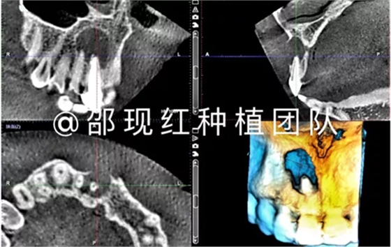「科普篇」你真的了解它嗎？——β-磷酸三鈣
