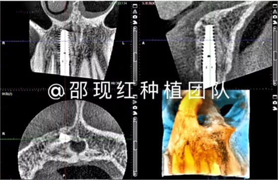 「科普篇」你真的了解它嗎？——β-磷酸三鈣