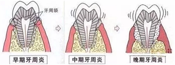 上海嘉?？谇谎芯克皇兰o(jì)牙周病的臨床進展