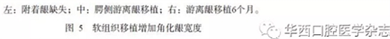 【專(zhuān)家共識(shí)】種植修復(fù)臨床評(píng)價(jià)標(biāo)準(zhǔn)