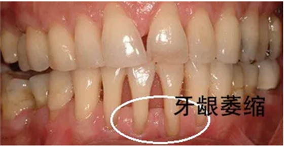 牙齦萎縮怎么辦？