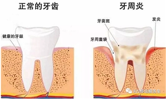牙齦萎縮怎么辦？