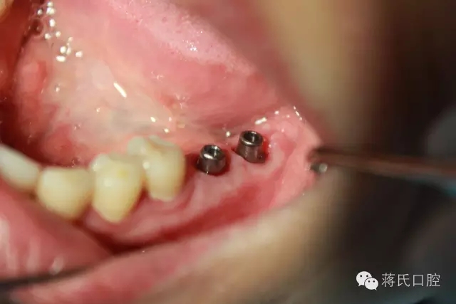 蔣氏口腔醫(yī)師風(fēng)采系列報道(五)左下六七即拔即種病歷分享 蔣氏口腔醫(yī)師風(fēng)采系列報道(五)左下六七即拔即種病歷分享