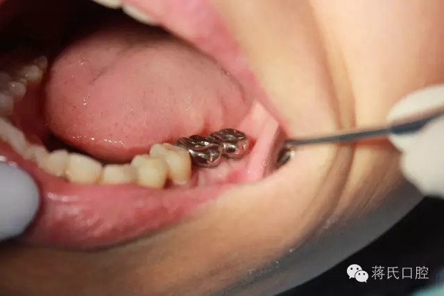 蔣氏口腔醫(yī)師風(fēng)采系列報道(五)左下六七即拔即種病歷分享 蔣氏口腔醫(yī)師風(fēng)采系列報道(五)左下六七即拔即種病歷分享