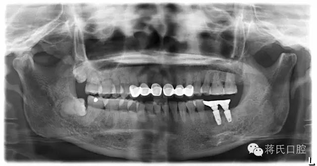 蔣氏口腔醫(yī)師風(fēng)采系列報道(五)左下六七即拔即種病歷分享 蔣氏口腔醫(yī)師風(fēng)采系列報道(五)左下六七即拔即種病歷分享