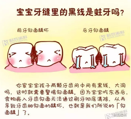 牙縫間的黑線是鄰面齲，還一壞壞倆，巧用它幫你渡過(guò)一“劫”