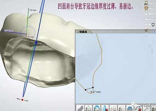 影響全瓷牙冠裂的因素有哪些？