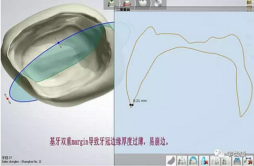 影響全瓷牙冠裂的因素有哪些？