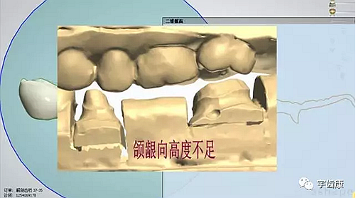 影響全瓷牙冠裂的因素有哪些？