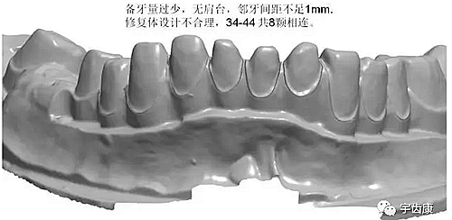 影響全瓷牙冠裂的因素有哪些？
