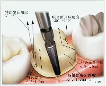 影響全瓷牙冠裂的因素有哪些？