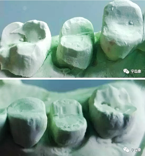 影響全瓷牙冠裂的因素有哪些？