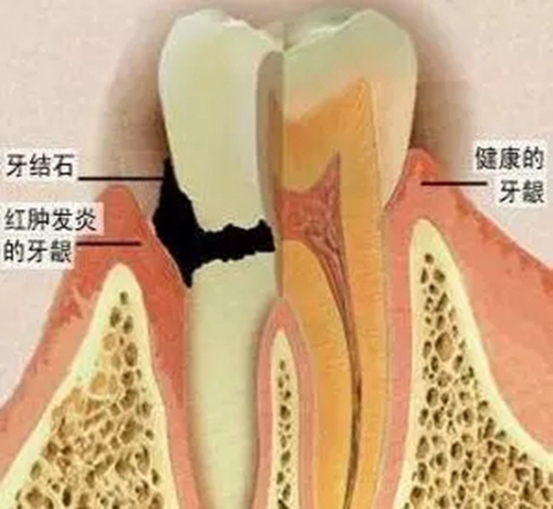 【愛(ài)牙科普】口腔謠言終結(jié)者——每天刷牙，洗牙該不該？！