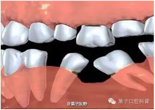 乳牙缺失致恒牙“亂長(zhǎng)”，這個(gè)“間隙保持器”可預(yù)防