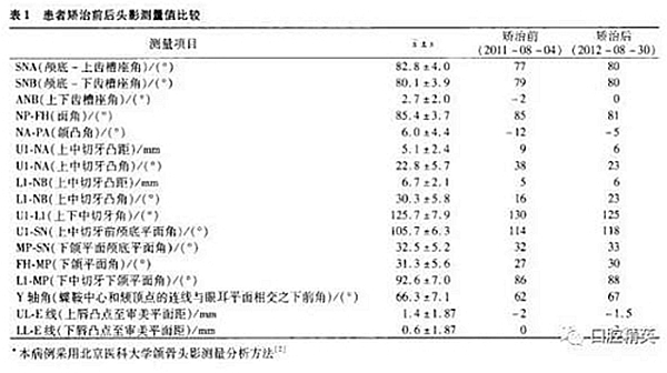 尖牙完全唇側錯位擁擠，矯正1例  