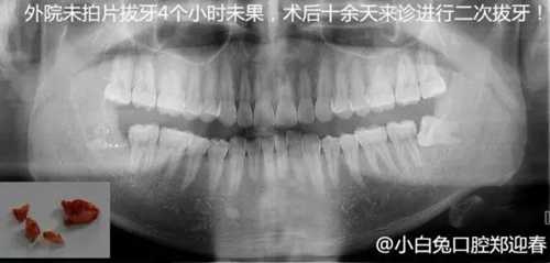 拔牙斷根的去與留？