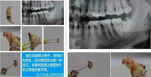 拔牙斷根的去與留？