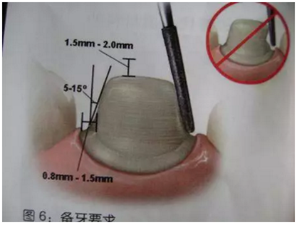 醫(yī)生，我的烤瓷牙上有個(gè)黑線怎么回事？