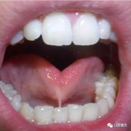口腔激光在系帶延長術(shù)中的應(yīng)用