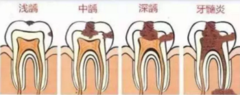 當(dāng)心“腹黑”齲齒，牙齒有個小洞也要補(bǔ)！