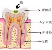 當(dāng)心“腹黑”齲齒，牙齒有個小洞也要補(bǔ)！